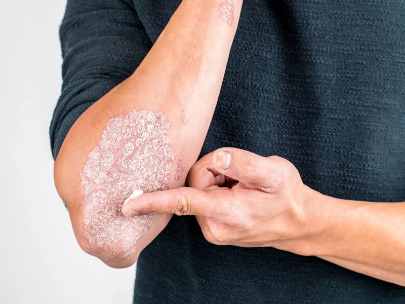 psoriasis treatment in hindi